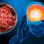 poremecaj-cerebralne-cirkulacije--uzrok_-simptomi_-lijecenje-1024x585