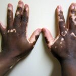 Vitiligo2